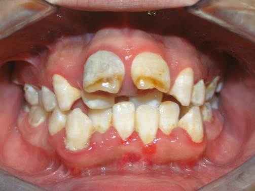 Apiñamiento dental antes del tratamiento