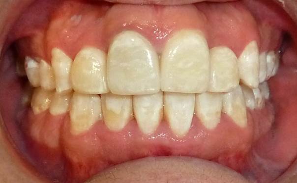 Alineación dental después del tratamiento