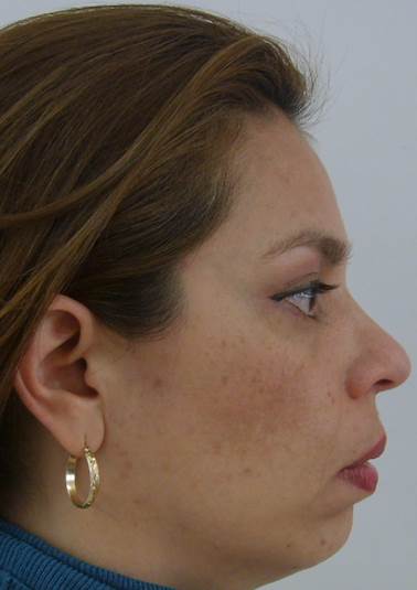 Vista de perfil antes del tratamiento de ortodoncia