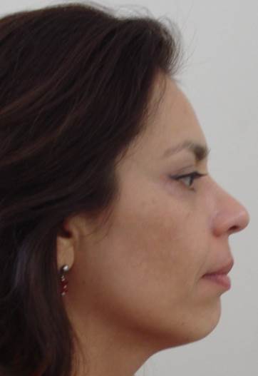 Vista de perfil después del tratamiento de ortodoncia