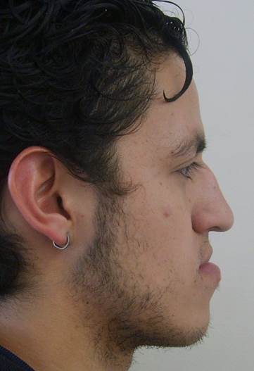 Perfil facial antes de la corrección quirúrgica de mordida cruzada anterior