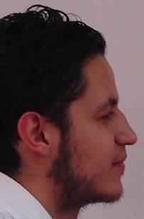 Perfil facial después de la corrección quirúrgica de mordida cruzada anterior