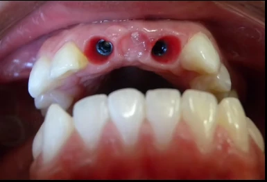Caso clínico antes del tratamiento con implantes dentales