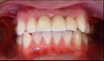 Resultado después de la rehabilitación con implantes dentales