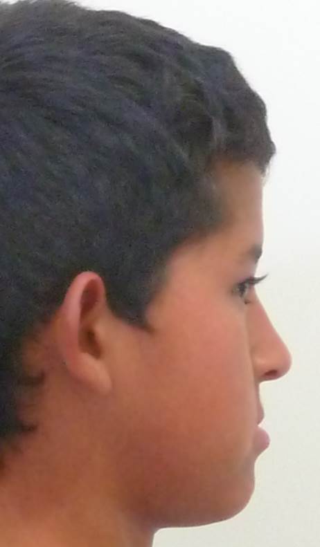 Perfil facial antes del tratamiento de ortopedia maxilar