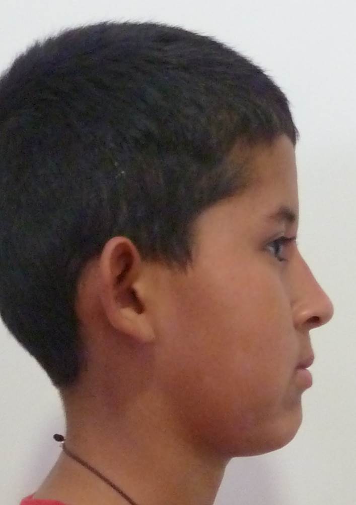 Perfil facial después del tratamiento de ortopedia maxilar