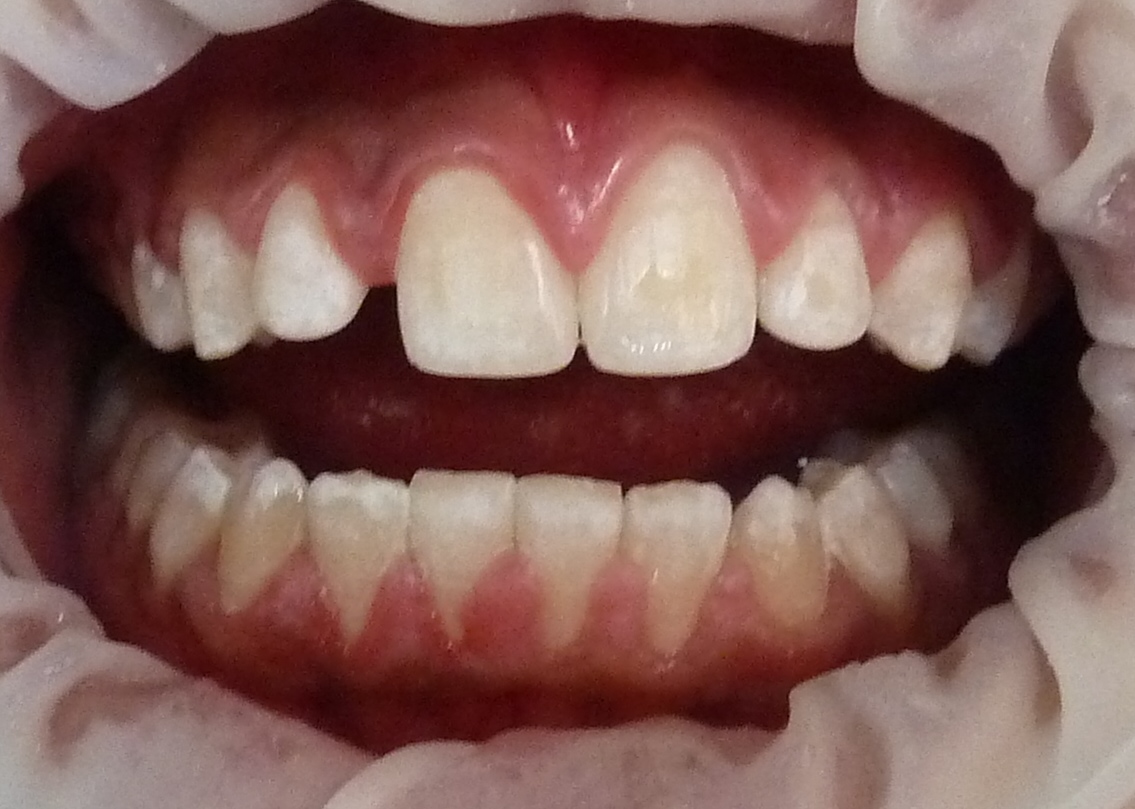 Antes de la restauración estética de dientes anteriores