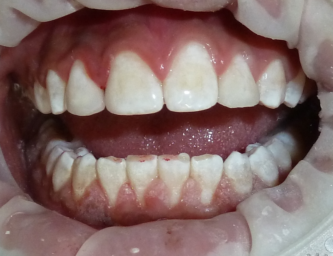 Después de la restauración estética de dientes anteriores