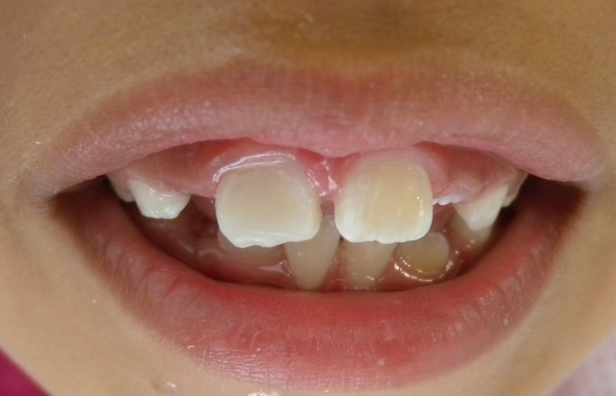 Antes de la restauración estética de dientes anteriores