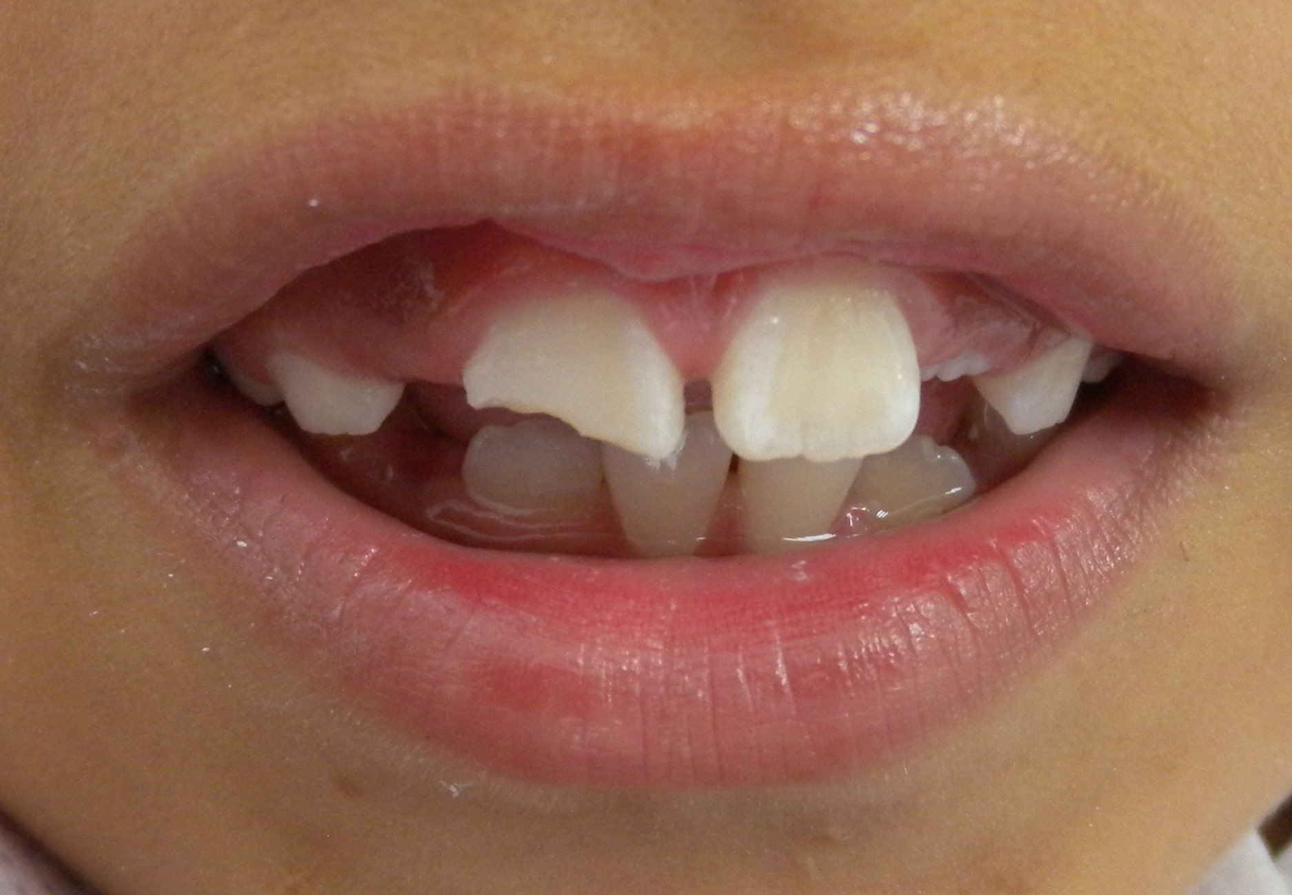 Después de la restauración estética de dientes anteriores